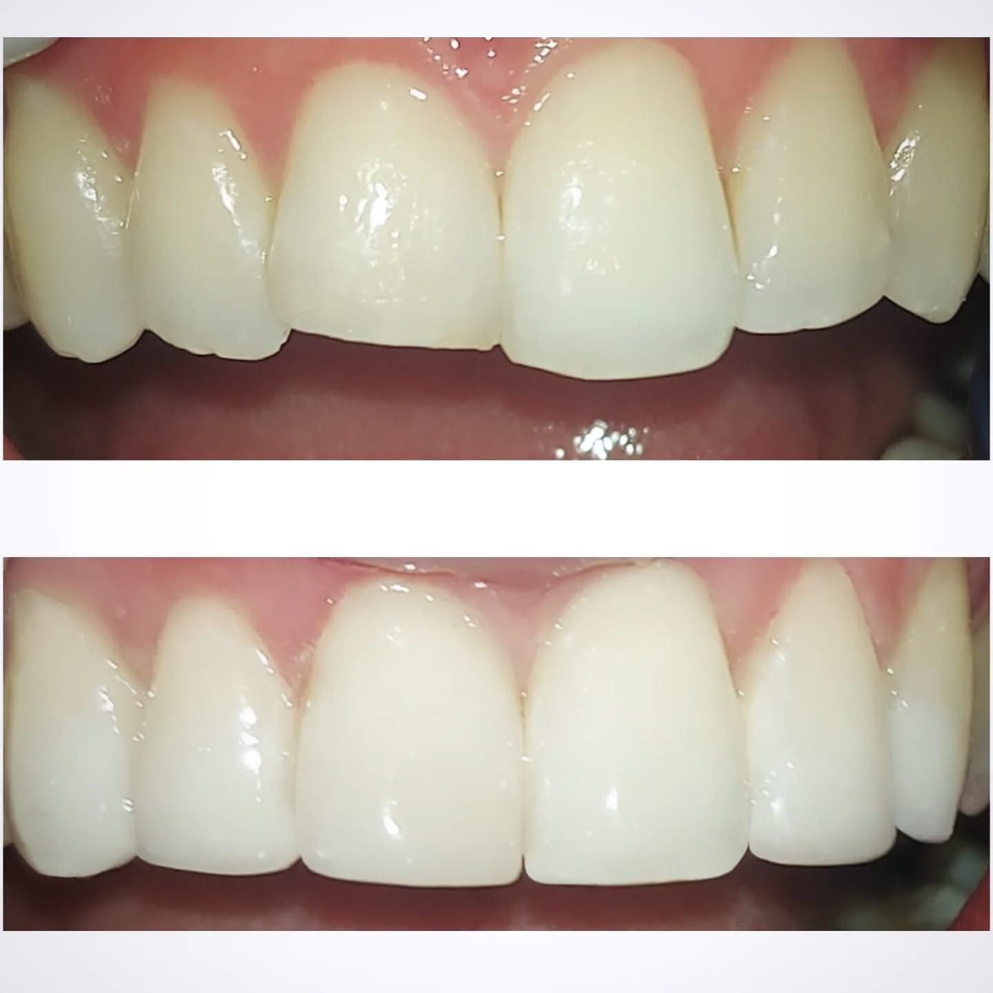 Resultado — Microdiseño de Sonrisa