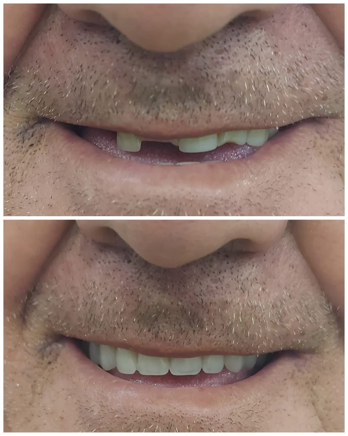 Resultado — Prótesis Dental