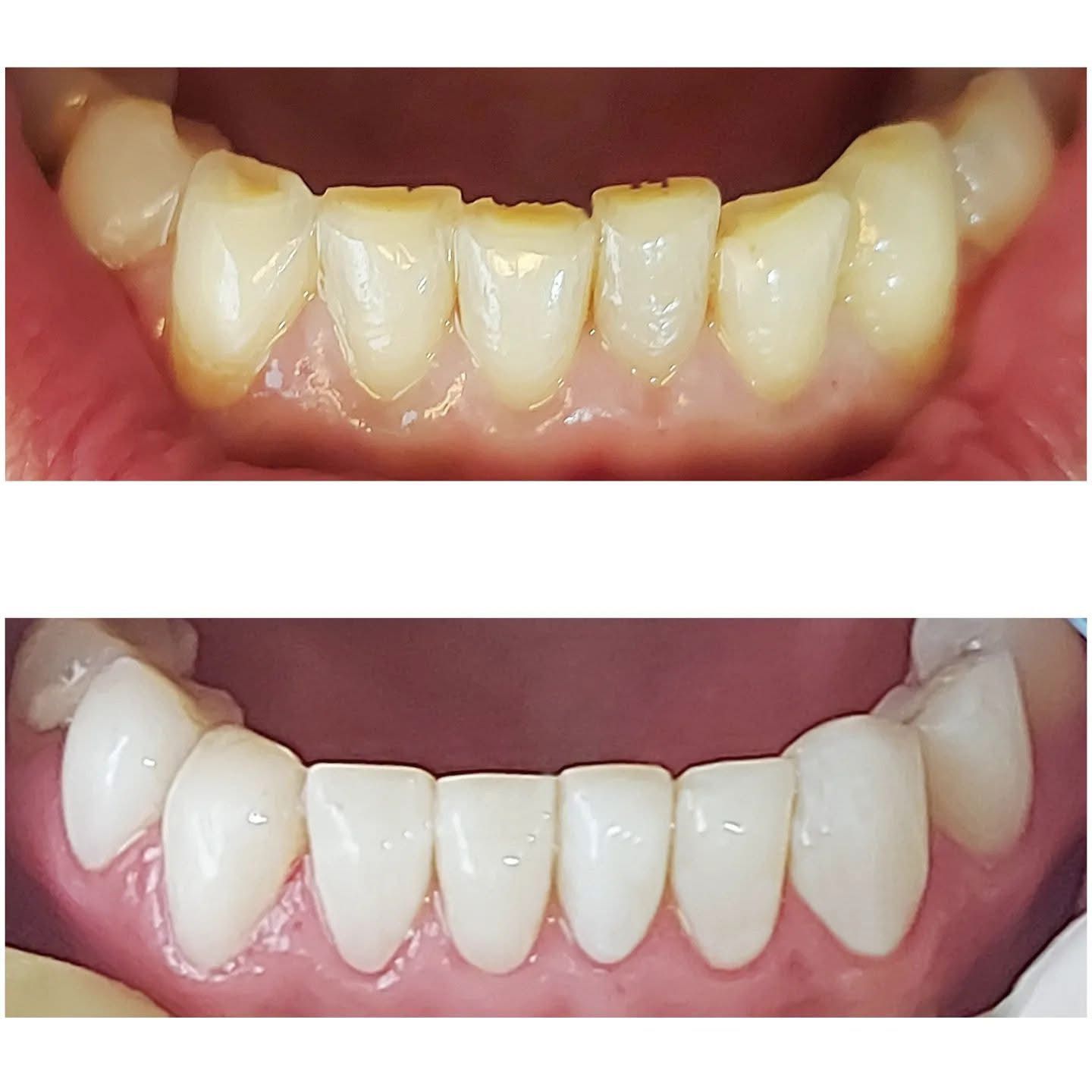 Resultado — Carillas Dentales