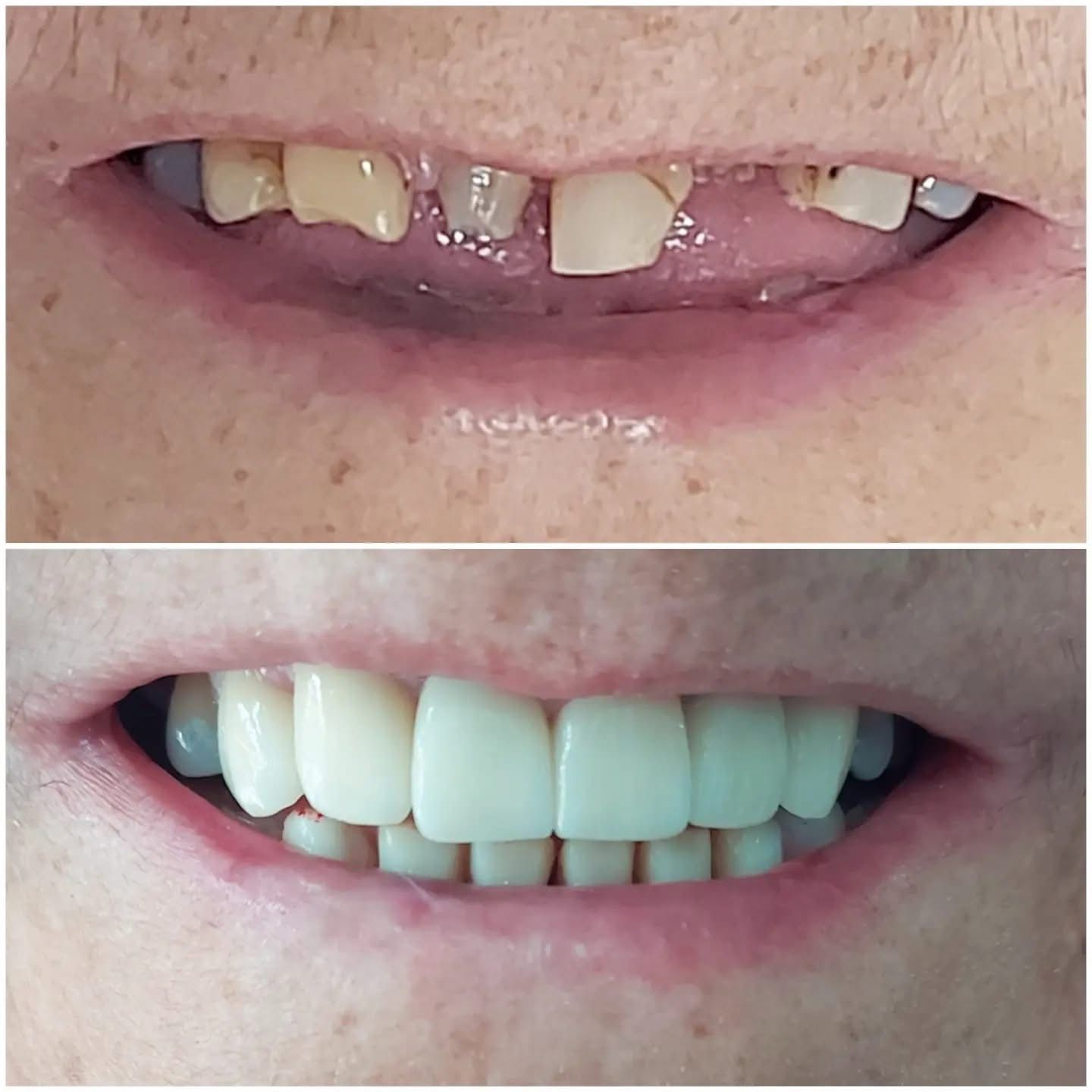 Resultado — Coronas Dentales