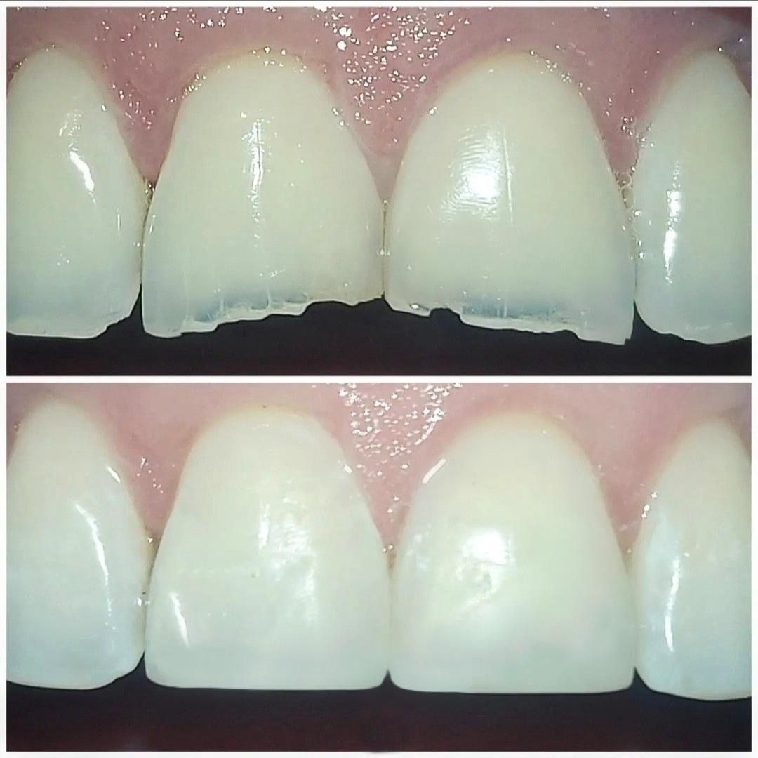 Resultado — Microdiseño de Sonrisa