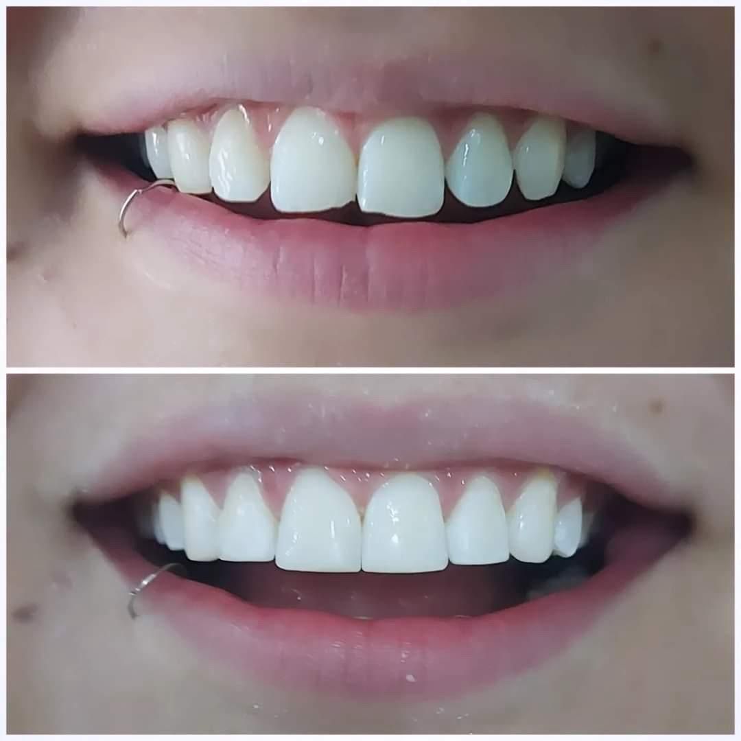 Resultado — Microdiseño de Sonrisa