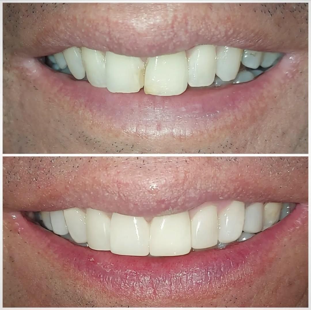 Resultado — Microdiseño de Sonrisa