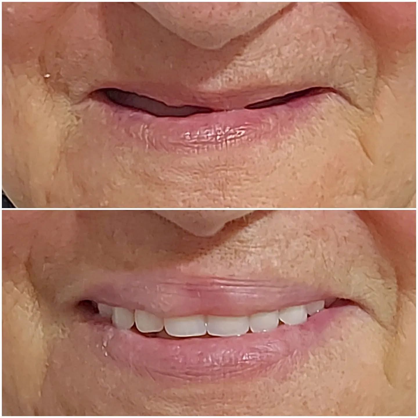 Resultado — Prótesis Dental