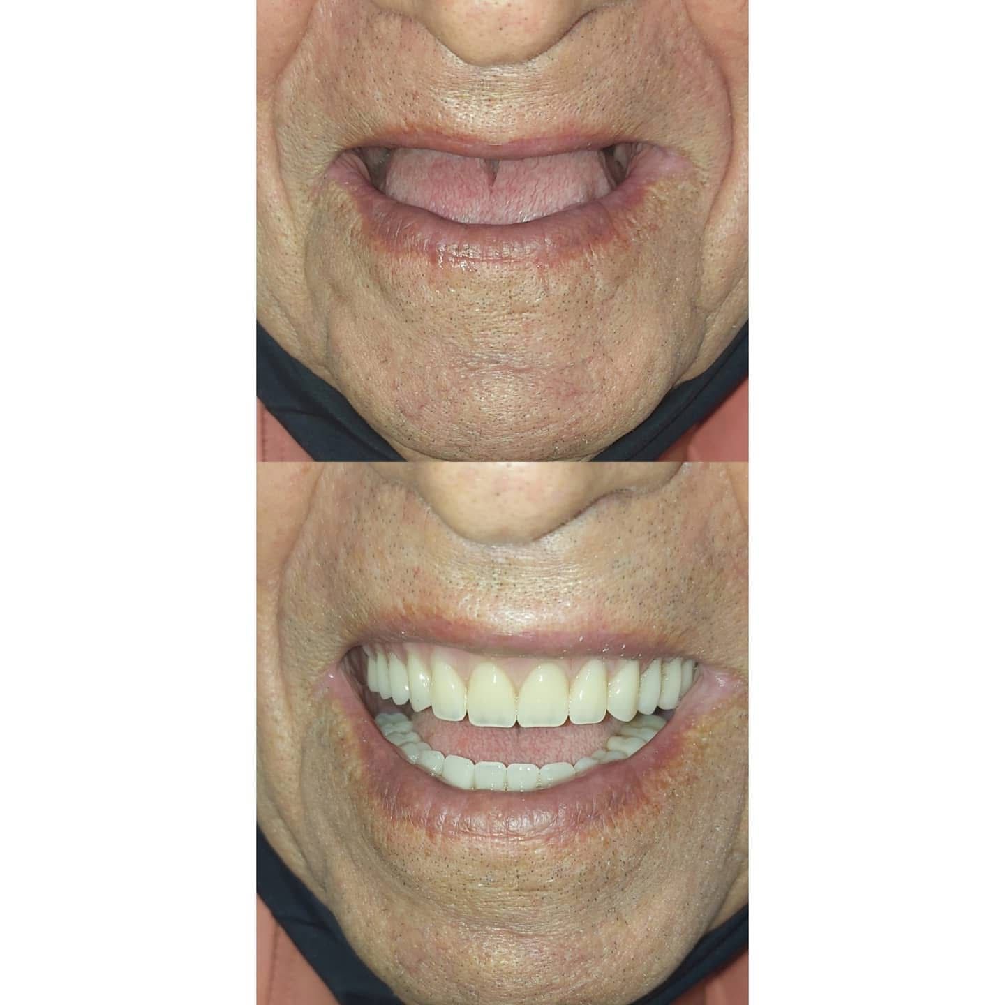 Resultado — Prótesis Dental