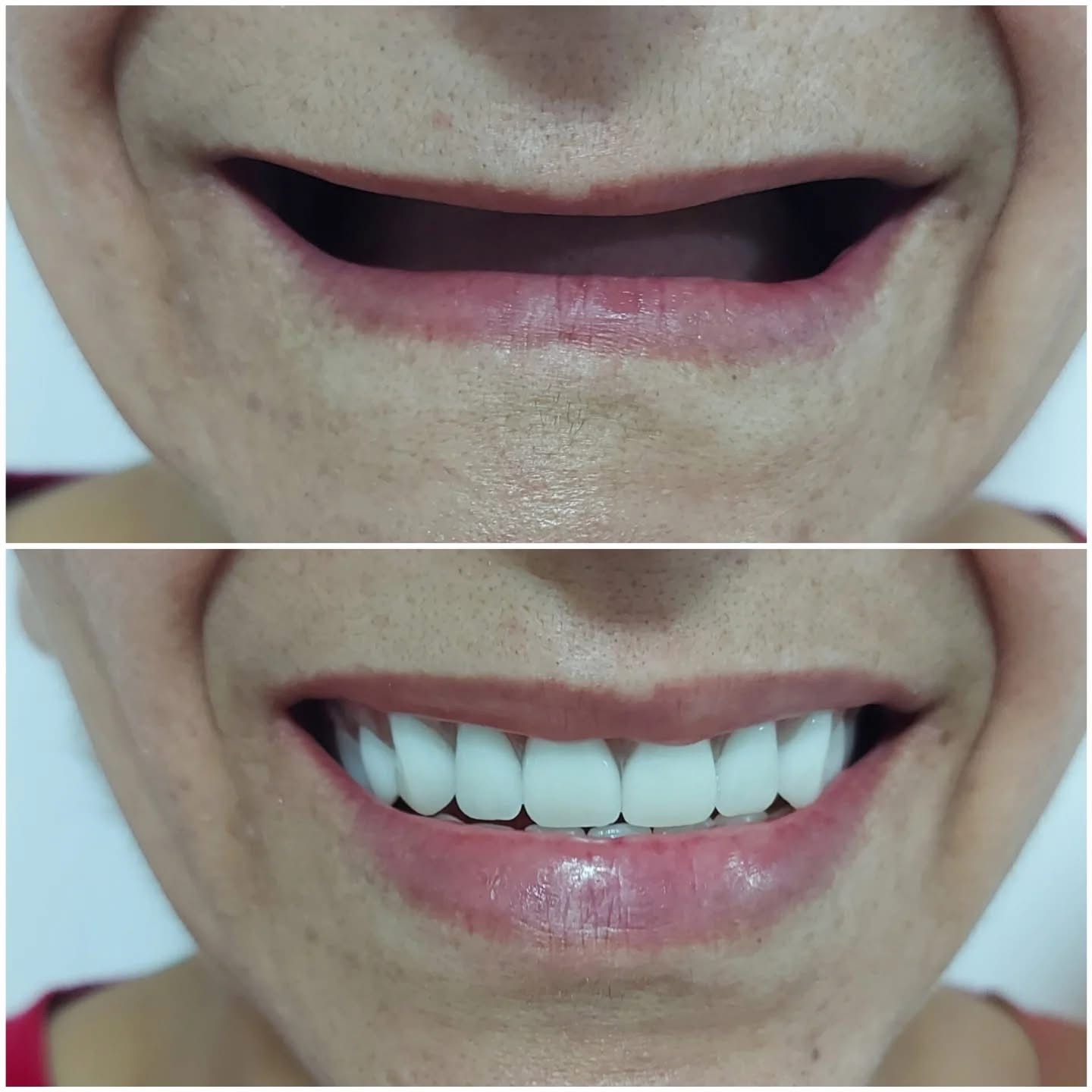 Resultado — Prótesis Dental