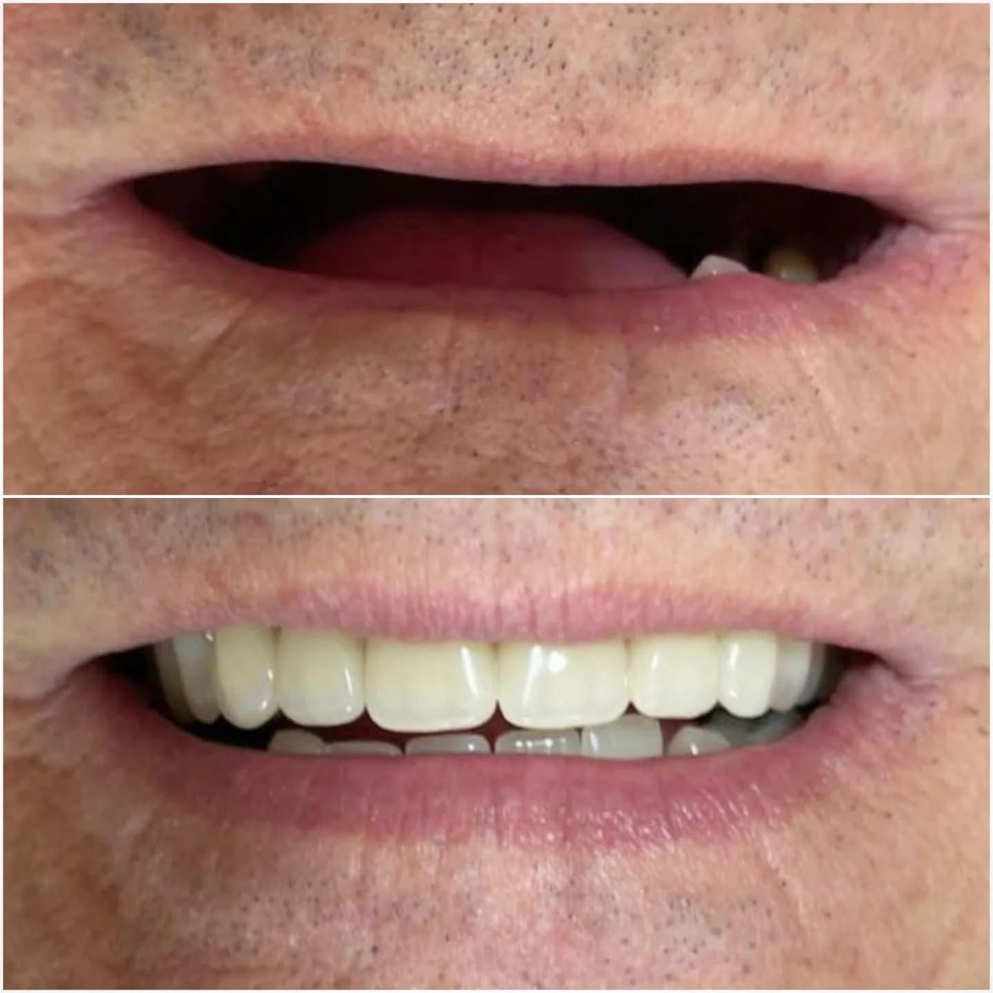 Resultado — Prótesis Dental