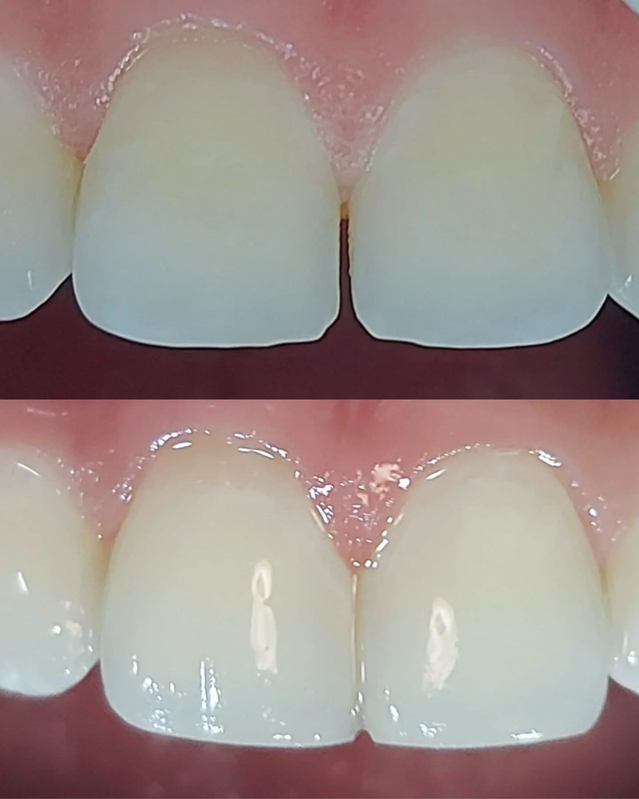 Resultado — Microdiseño de Sonrisa